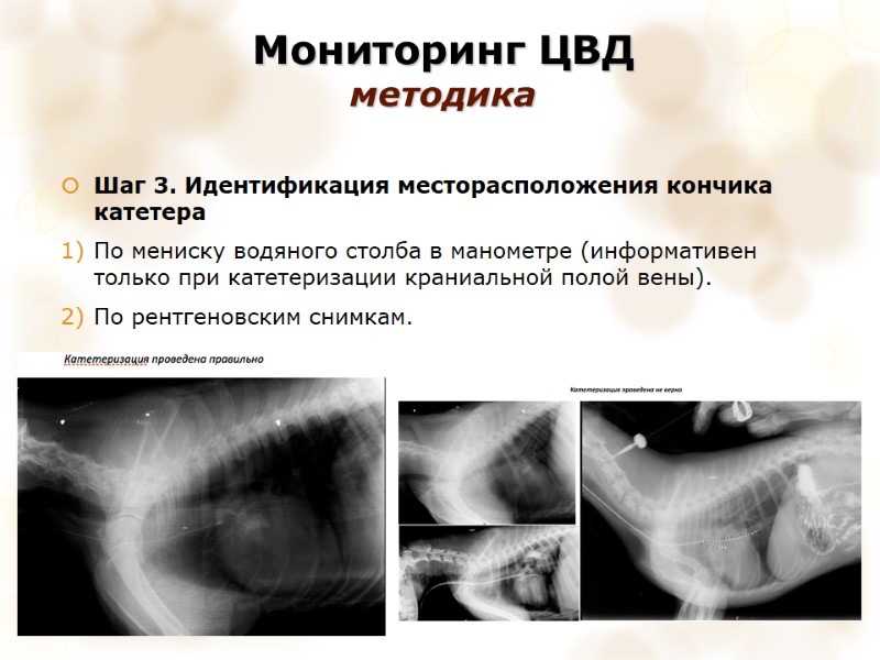 Мониторинг ЦВД  методика Шаг 3. Идентификация месторасположения кончика катетера По мениску водяного столба